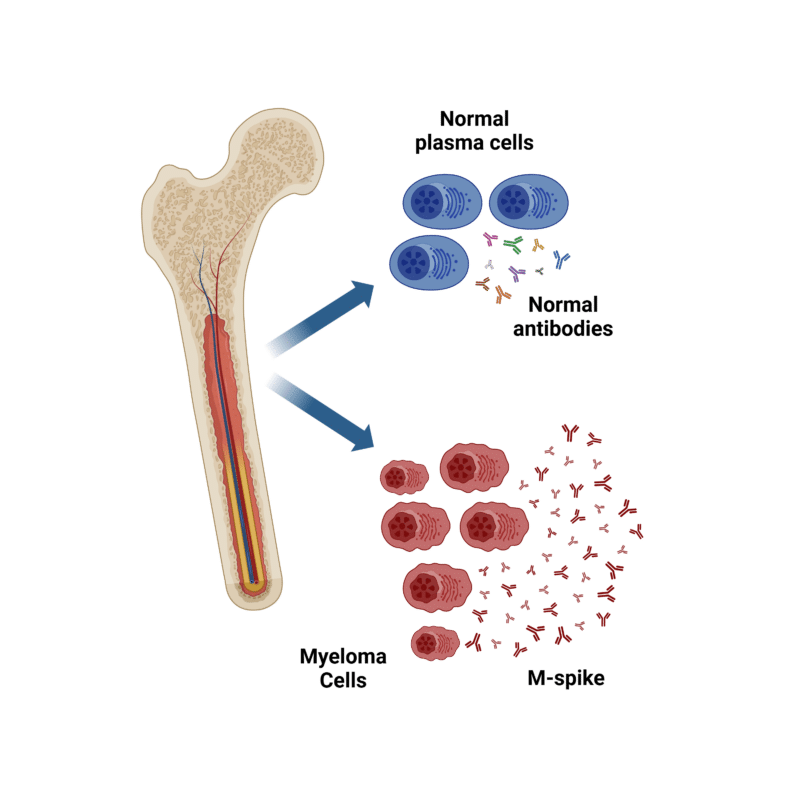 M-spike proteins produced by cancerous myeloma cells in the bone marrow.